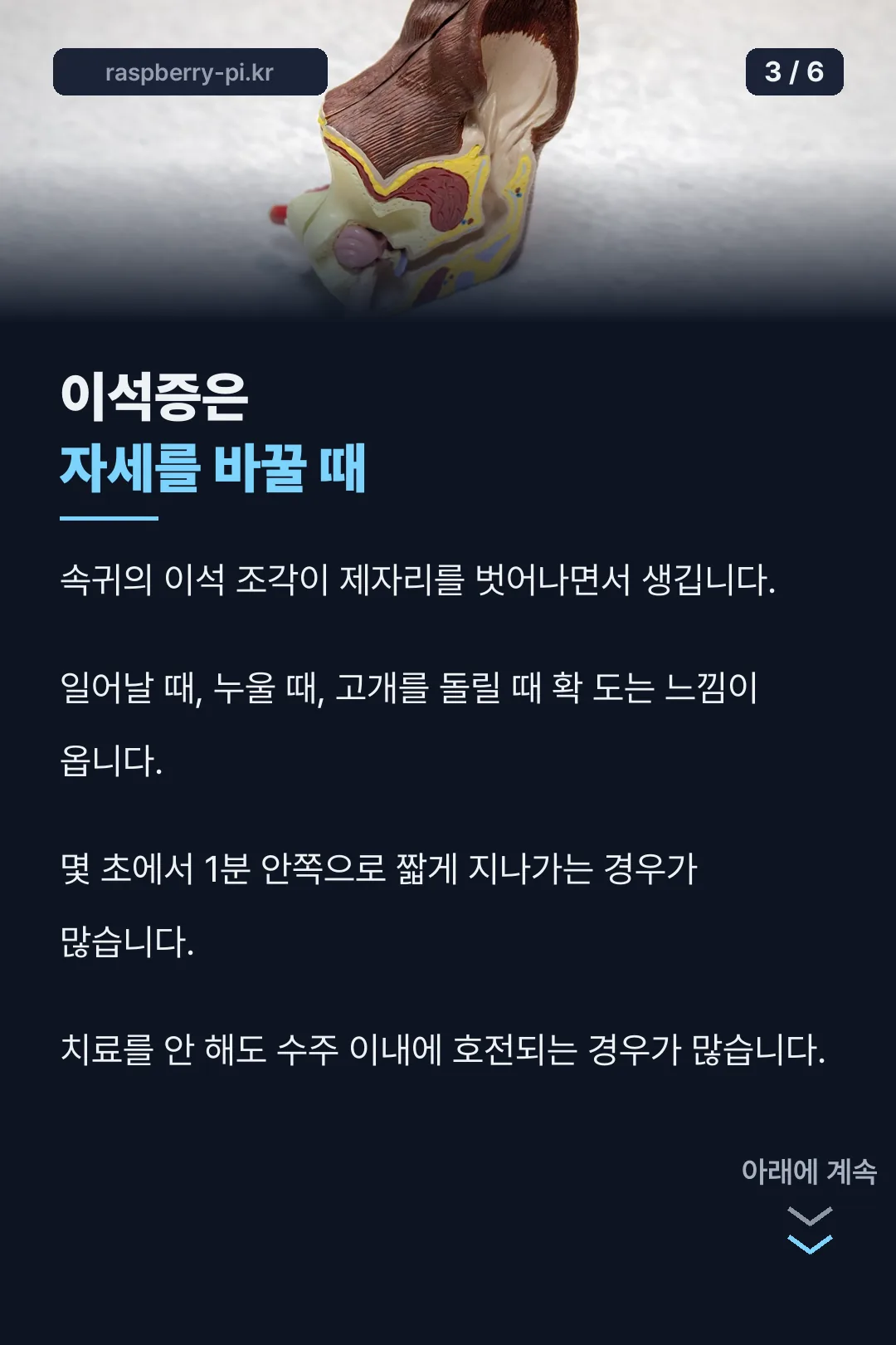 이석증 특징